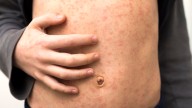 Measles in WA: Sixth case recorded in September, authorities urge families to check jab status before holidays