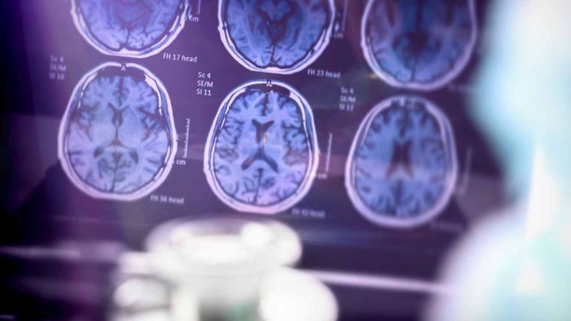Edinburg event shares latest Alzheimer's care, treatment insights