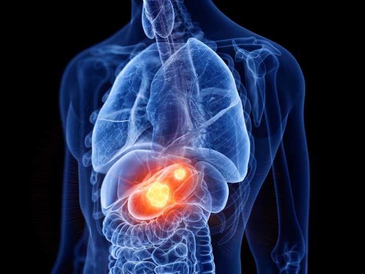 Exosomal Liquid Biopsy Shows High Accuracy for Early Gastric Cancer Detection