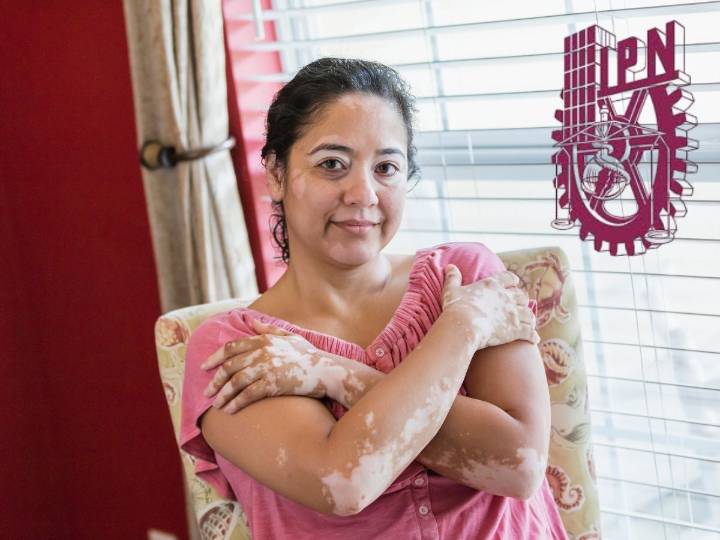 IPN investiga si existe vínculo entre la obesidad y el vitíligo