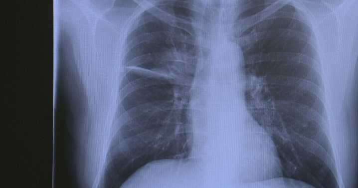 Colorado lung cancer doctor reveals his own diagnosis to help others