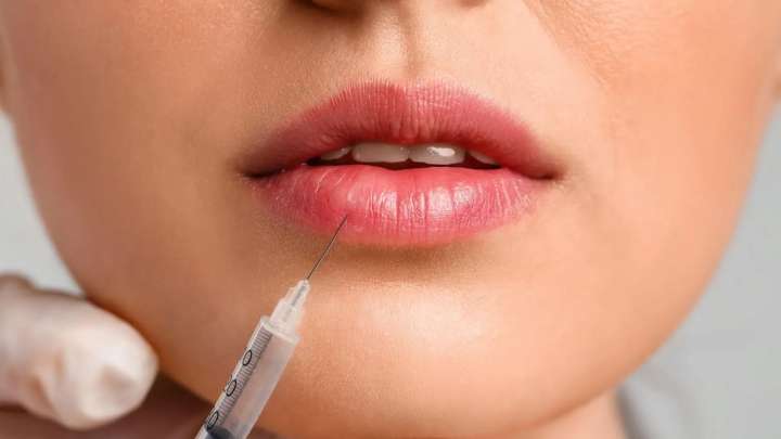 Lip filler vs. lip flip — which one’s right for your pout?
