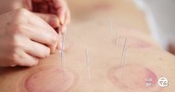 Ask Dr Nandi: Is acupuncture a way to treat debilitating backaches?