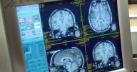 DOD grant funding brain injury study with UVA School of Medicine