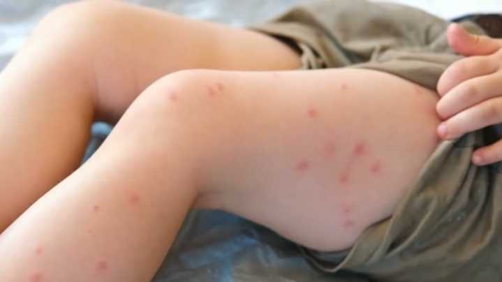 Measles cases spiking across Queensland
