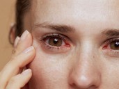 Tipos de alergias oculares