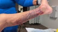 Vibrio vulnificus cases rise to 28 in Florida, 3 more reported