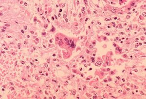 Child dies of rare measles complication years after infection