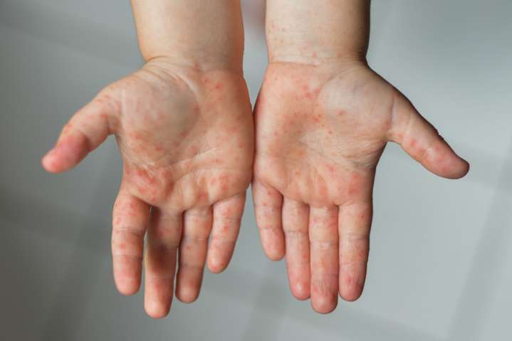 Brote de enfermedad Boca, Mano y Pie preocupa a padres: claves para prevenir el contagio