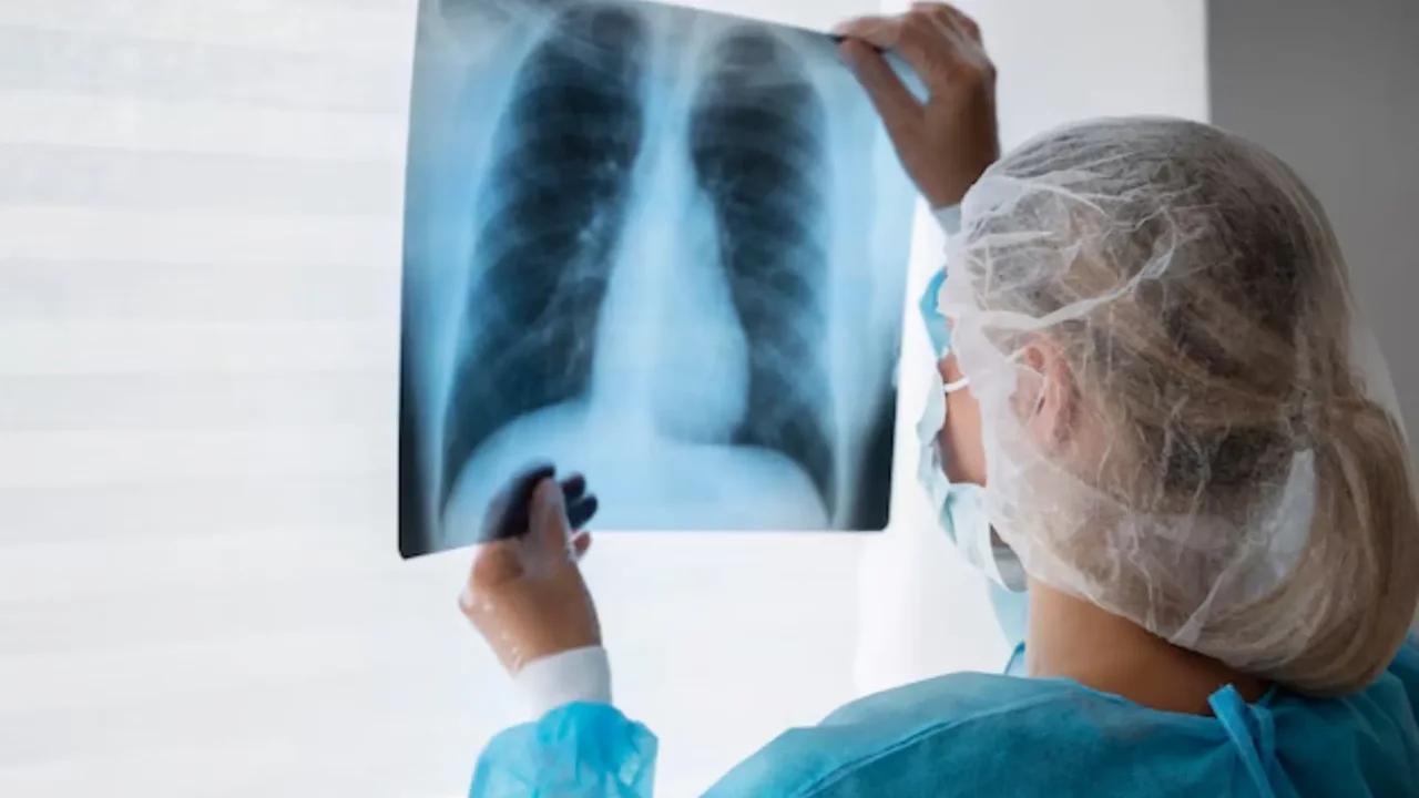 Ojo, viajeros: Cartagena registra más de 300 casos de tuberculosis