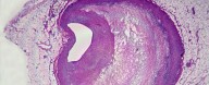 Plastic Discovered In More Than 50% of Plaques From Clogged Arteries