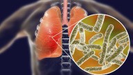 What people should know about Legionnaires’ disease