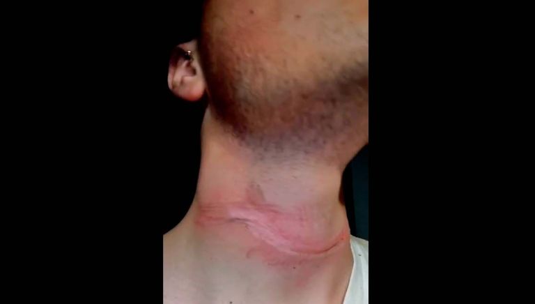 Villa de Merlo: un joven de 22 años casi es decapitado por un cable caído en la calle