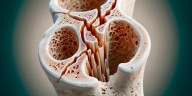 Cómo funciona la innovadora técnica que permitiría revertir el avance de la osteoporosis