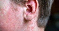 SC had 1 measles case in 2024, now it has 4 in 2025. Where was the latest case?