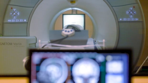 'Best news' for Huntington's disease community comes with unanswered questions