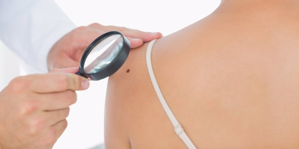 El uso de un tipo de vitamina B3 reduce el riesgo de cáncer de piel