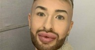 Man who spent £3k on fillers totally unrecognisable after having them dissolved