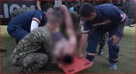 Putumayo: Un soldado sufrió quemaduras en el 75% de su cuepo