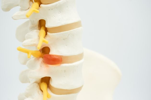 Stay Well: What is a slipped disc and does it always require surgery?
