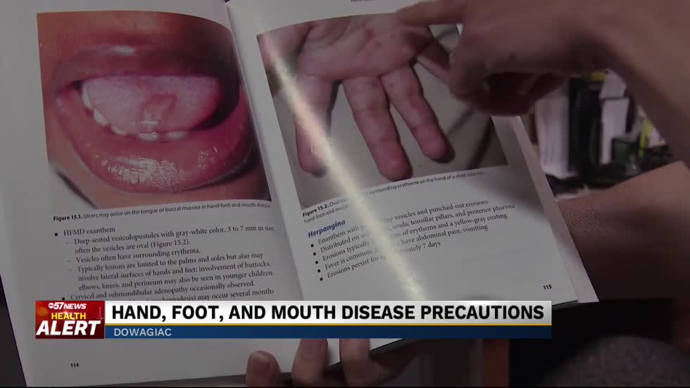 Hand, Foot and Mouth Disease cases confirmed at Dowagiac Middle School