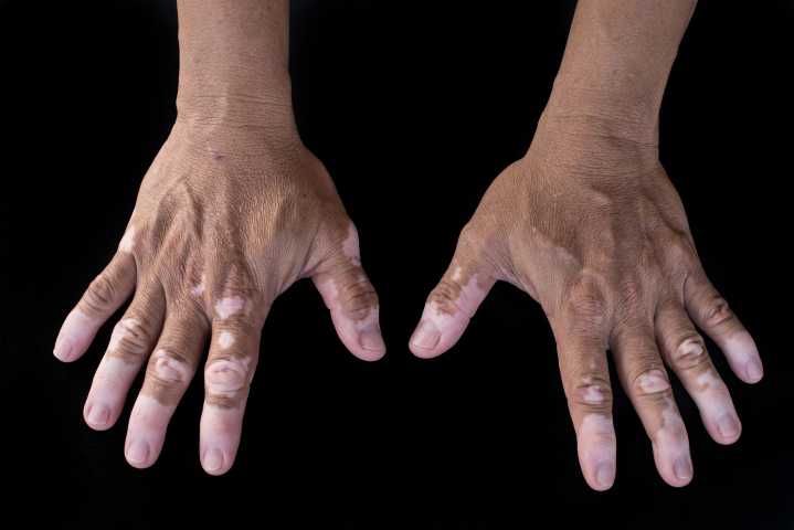 New Data at EADV Could Offer Hope, Address Gaps in Dermatology Care
