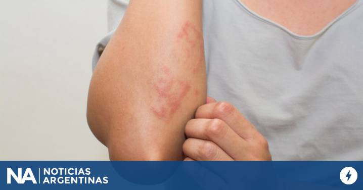 Dormir bien, un desafío cotidiano para quienes viven con dermatitis atópica