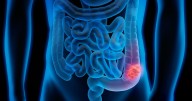 Un nuevo modelo matemático mejora la detección precoz del cáncer colorrectal