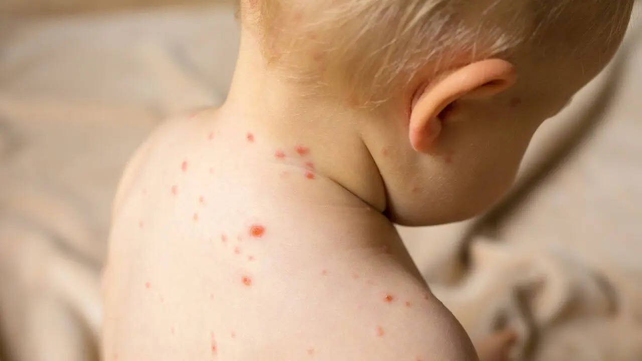 Clade 1 Mpox Virus Detected in US Wastewater; How High Is the Risk of Catching The Virus?
