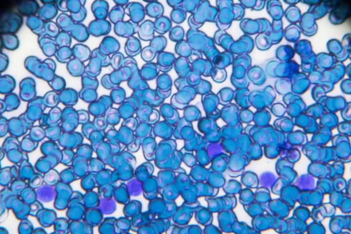 AI Support for Blood Cancer Patients Limited to General Questions
