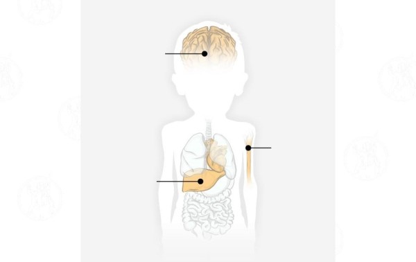 Esto es lo que la desnutrición le hace al cuerpo de los niños