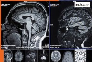 These rare brain disorders make you completely fearless; what are they, and what causes them? Doctors warn...