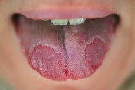 What is 'geographic tongue'?