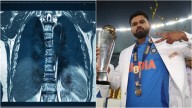 Blunt trauma explained: How abdominal injury like Shreyas Iyer’s can affect athletes