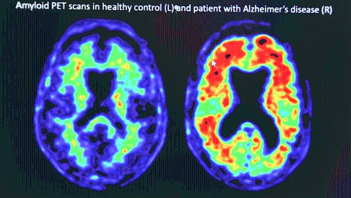 South Carolina struggles with neurologist shortage, rising dementia
