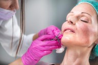 Hyaluronic Acid Fillers Restore Facial Volume, Fullness