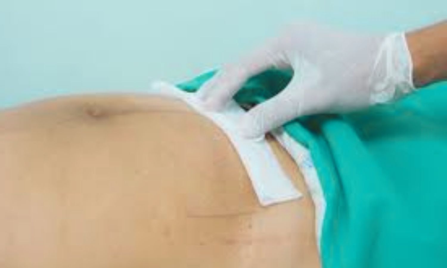 Synthetic Mesh Remains Standard for Inguinal Hernia Repair, suggests JAMA study