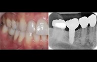 Intermediate Abutment-Healing Cap System Ensures Accurate Single Implant Scans, suggests study