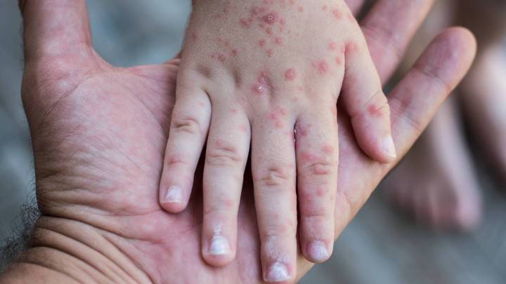 49 niños víctimas de coxsackie