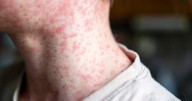 Measles cases quickly rising in Minnesota. Here's where outbreaks are spreading in the U.S.