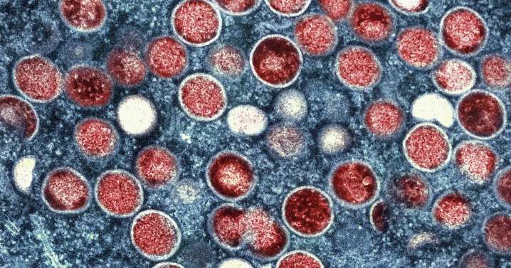 Mpox strain that may be more severe, easily spread, found in L.A. County for first time