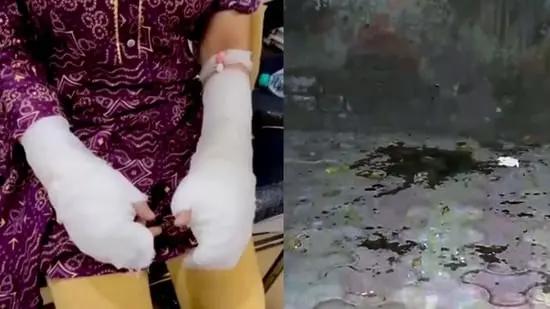 Twist In Delhi Acid Attack: Did Female Student’s Dad Plot Incident To Frame Accused?