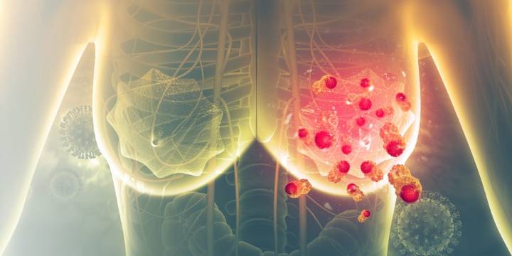¿Por qué ocurren las metástasis del cáncer de mama?