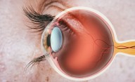FDA Approves Eydenzelt, Additional Eylea Biosimilar
