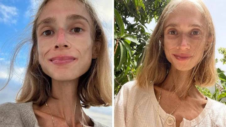 Una influencer murió por desnutrición: cómo era la dieta estricta que realizó durante meses