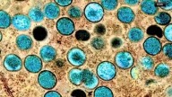 Possible local mpox spread investigated after 3 cases with no travel history reported