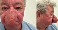 Scots granddad unable to kiss wife for years due to nose continuously growing