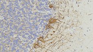 Blood Signals May Predict Multiple Sclerosis 7 Years Before Symptoms