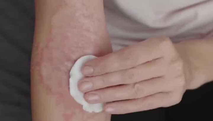 Doscientas mil personas viven con psoriasis en Chile