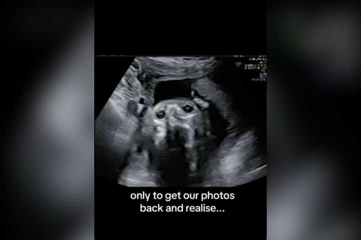 Mom-To-Be Has Ultrasound Scan, Left Stunned by What She Realizes Afterwards